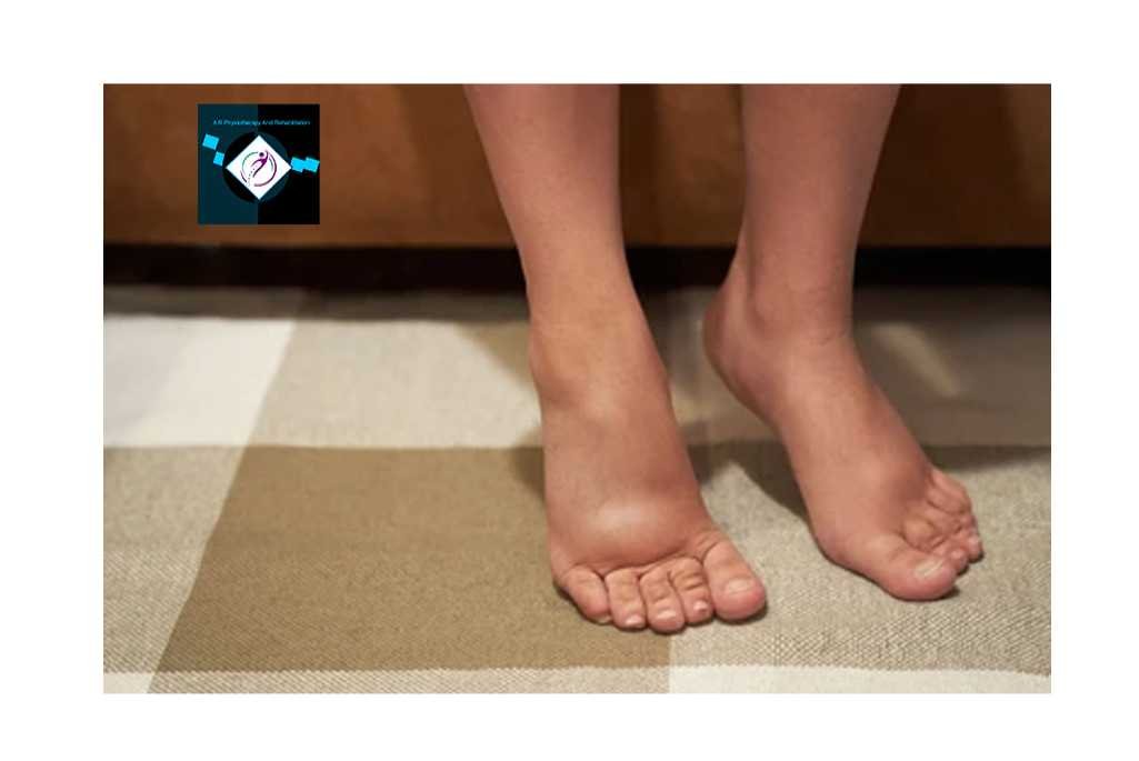 Swelling feet