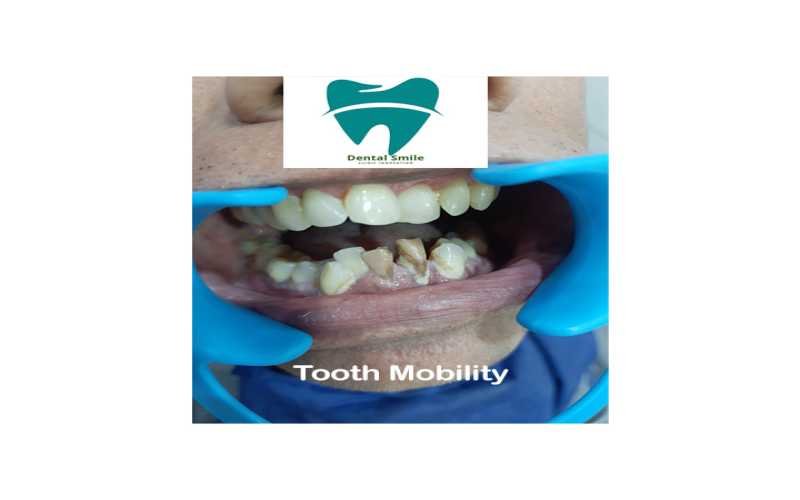 Tooth Mobility