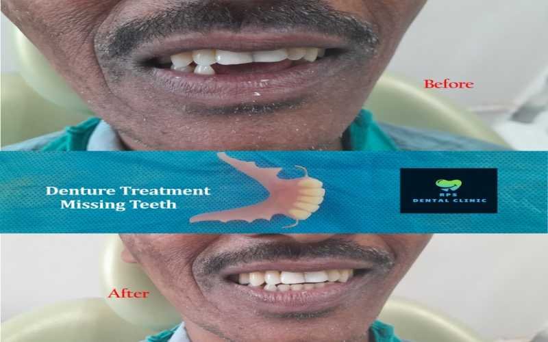 Denture Treatment For Missing Teeth
