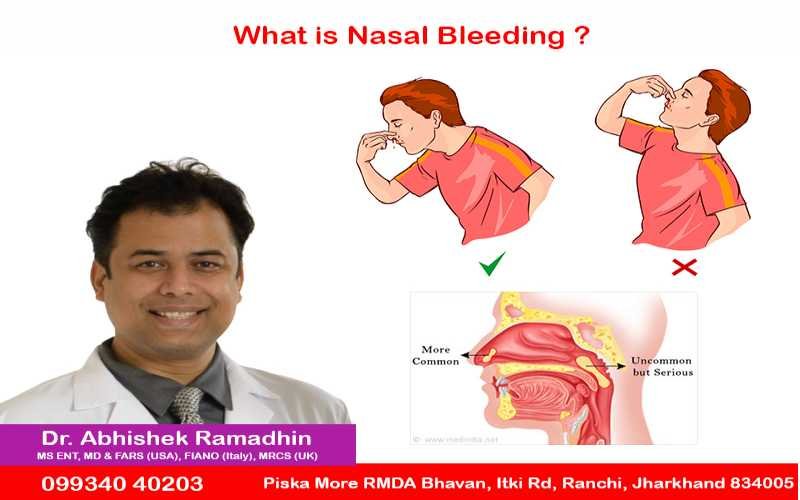 Nasal Bleeding