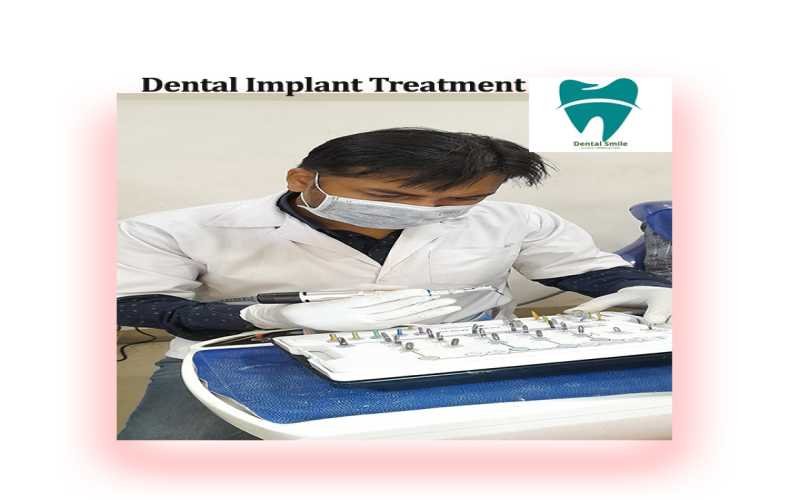 Dental Implant Treatment in Ranchi