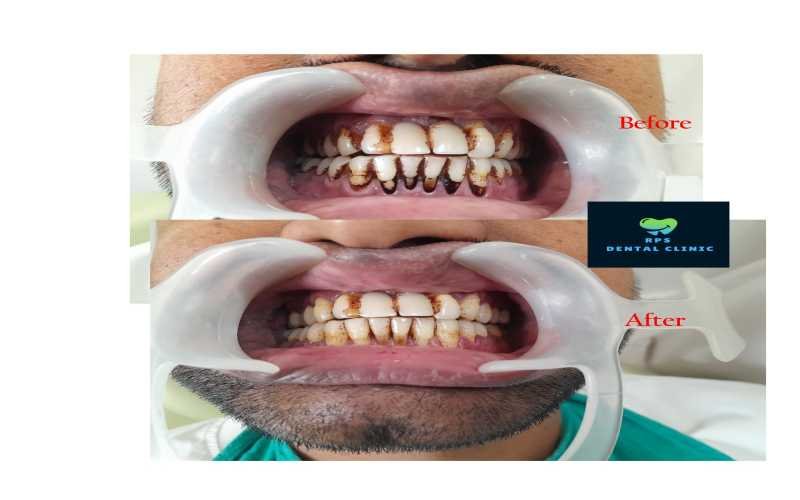 Teeth cleaning for gutka and tobacco chewers