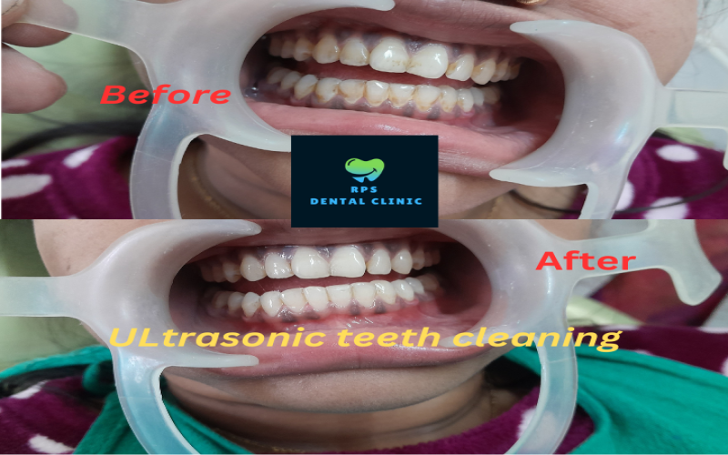 Ultrasonic teeth cleaning services done by our dentist in Ranchi