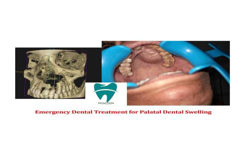 emergency dental treatment for palatal dental swelling