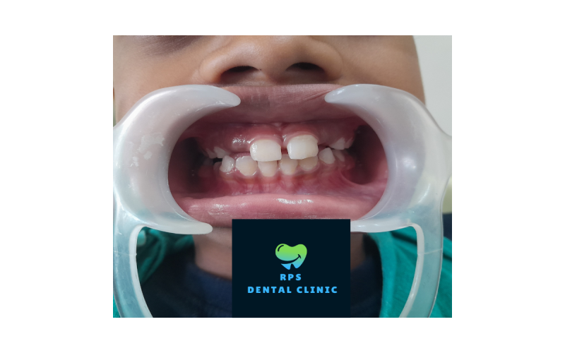 Pediatric orthodontist for missing maxillary lateral incisor