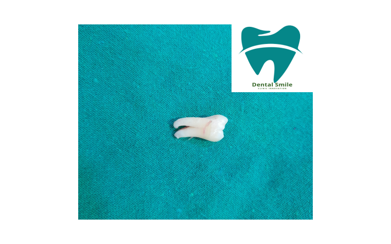 Removal of wisdom tooth or third molar