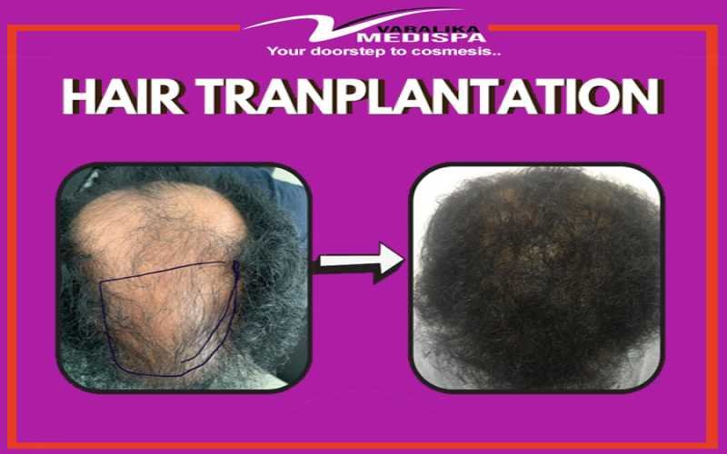 Best hair transplant clinic in Ranchi,