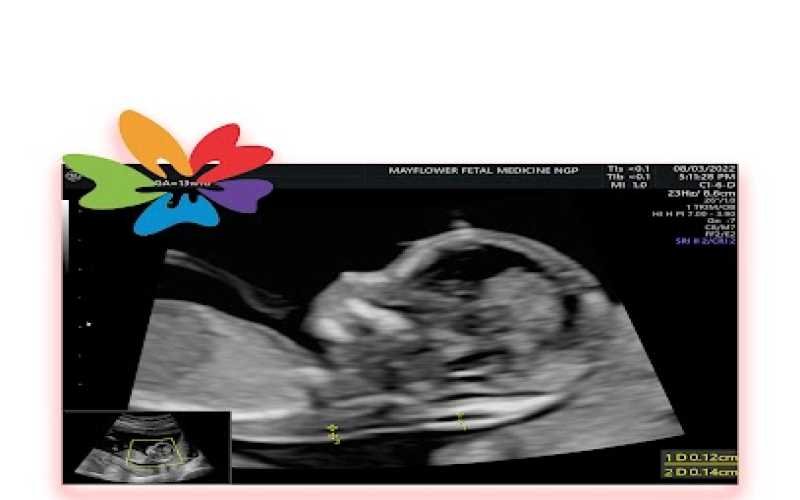 11 to 14 weeks scan for the aneuploidy screening (downs screening)with risk assessment of soft markers