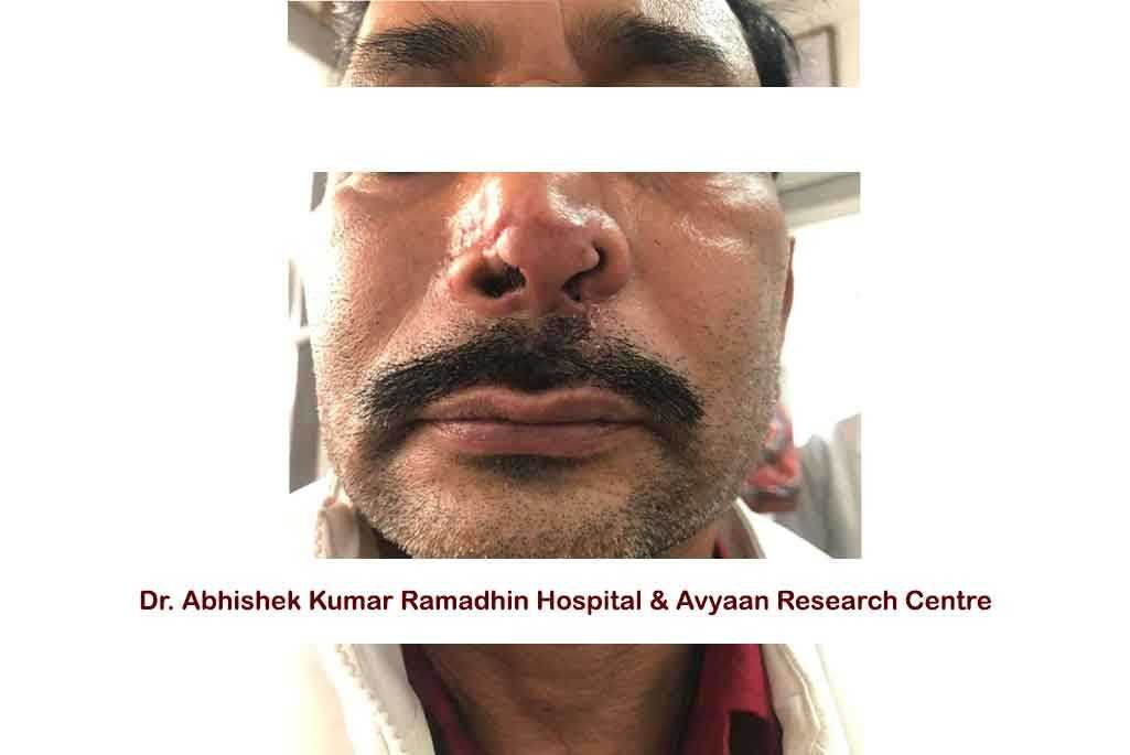 Reconstruction Of Broken Nose
