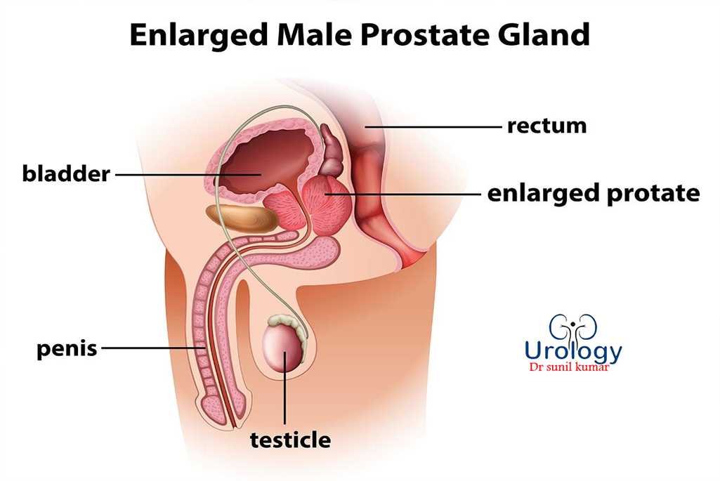 Prostate Disease Treatment