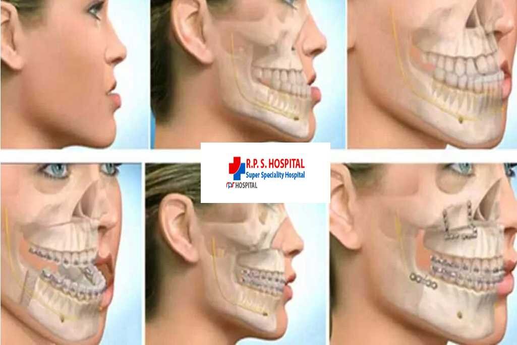 Maxilo-Facial Surgeery