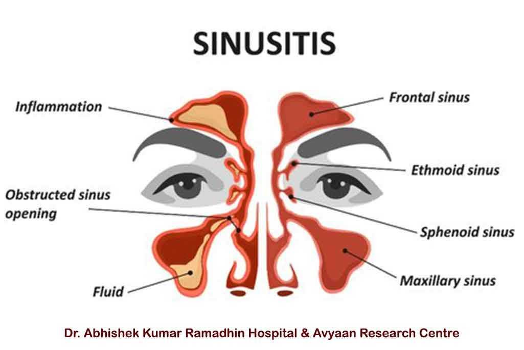 Sinusitis Treatment